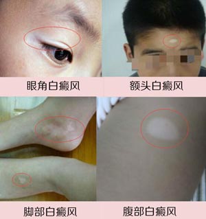 白殿疯病早期图片2.jpg