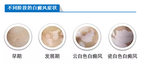 白斑不同颜色.png