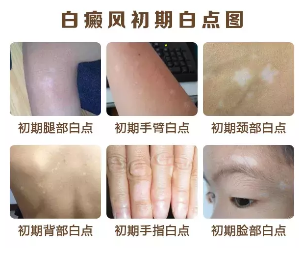 白癜风初期白点.png